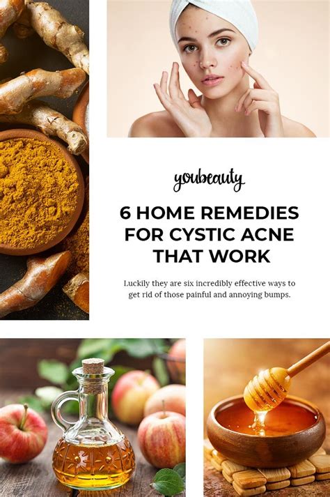 6 Home Remedies For Cystic Acne That Work We All Know That Cystic Acne