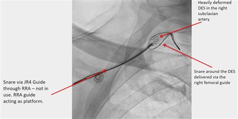 Case Study Coughing Concomitant With Stent Deployment Leading To