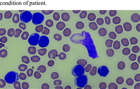 Peripheral Smear Showing Abnormal Mature Looking Lymphocytes