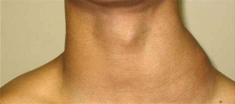 Neck Swelling Ent Conditions And Tratment From Subang Ent