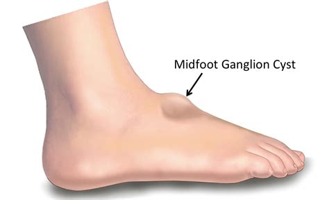 Ganglion Foot Cyst Foot And Podiatry Surgery