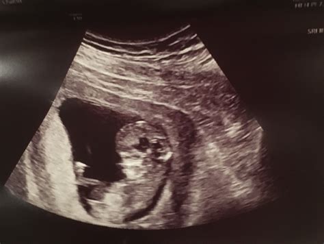 Post Your Ultrasounds Here Page The Bump Hot Sex Picture