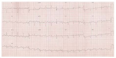 It has several possible implications. ECG-sinus tachycardia, right bundle branch block, right ...