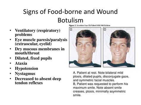 Botulism Symptoms Botulism Symptoms Causes Prevention And Types