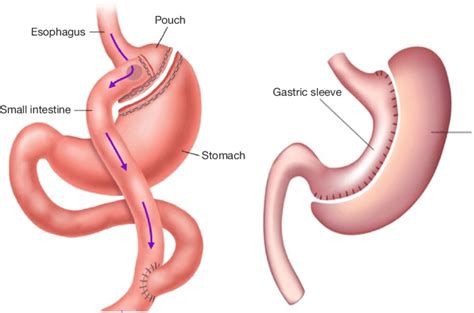 Picture Of Roux En Y Gastric Bypass And Sleeve Gastrectomy Download Scientific Diagram