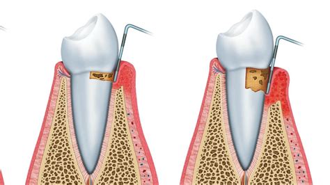 Gingivitis Vs Periodontitis Four Stages Of Gum Disease Periodontal Disease Treatment Houston Tx