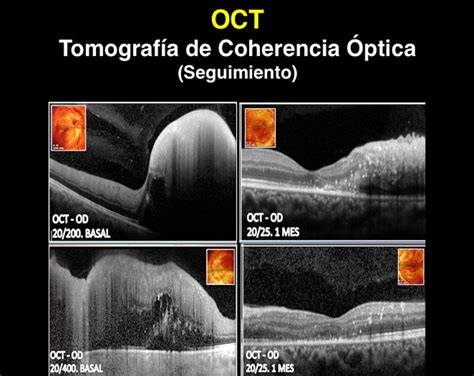 Tomografía De Coherencia Óptica Oct Retina Y Mácula Consultores