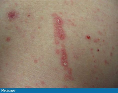 Linear Rash Pictures Photos