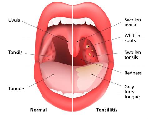 What Are The Most Common Signs Of Tonsillitis With Pictures