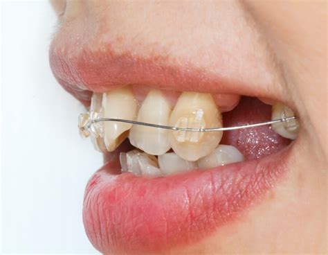 Everything You Need To Know About Crooked Teeth Treatment
