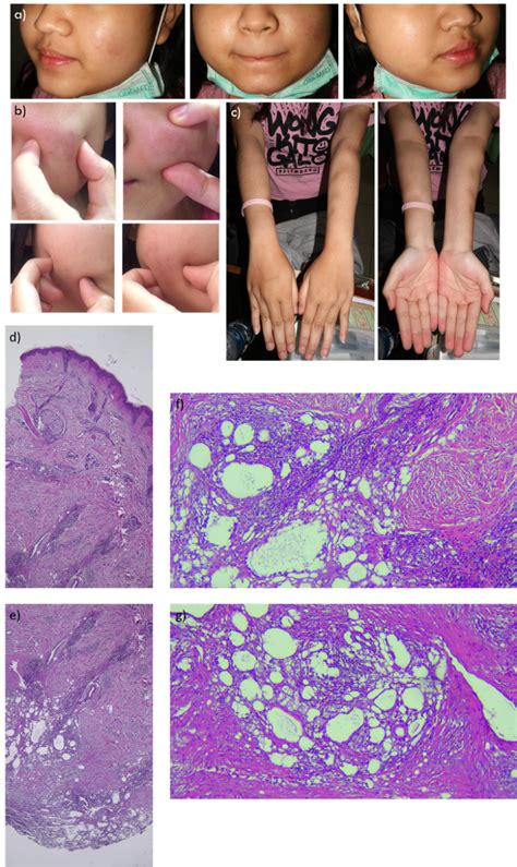 Lupus Panniculitis Lesions Of An 18 Year Old Female Patient Who