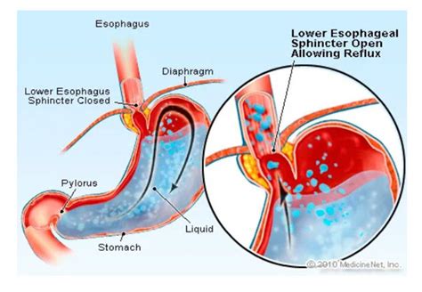 Integrative Approaches To Gastroesophageal Reflux Disorder Gerd