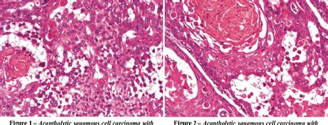 Figure 2 From Acantholytic Squamous Cell Carcinoma Pathological Study