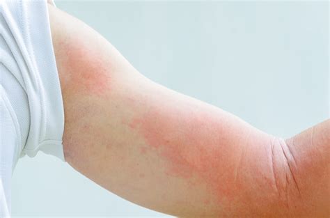 Kenali Dermatitis Herpetiformis Penyakit Autoimun Yan Vrogue Co