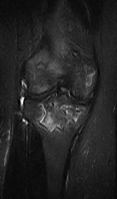 Knee Avascular Necrosis Mri Sumers Radiology Blog