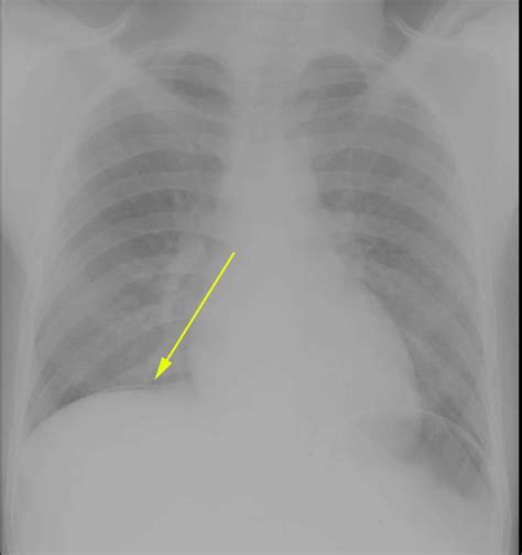 Pneumoperitoneum From Perforated Duodenal Ulcer On X Ray X Rays Case