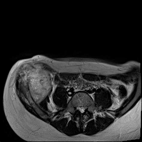 Osteosarcoma Of The Iliac Crest Body Mr Case Studies Ctisus Ct Scanning