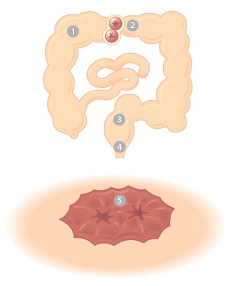 Ileostomy Ainscorp