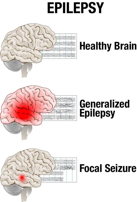 Epilepsy Neurological Disorders Epilepsy Epilepsy Facts