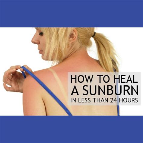 How To Heal A Sunburn In Less Than 24 Hours Heal Sunburn Sunburn Loose Skin