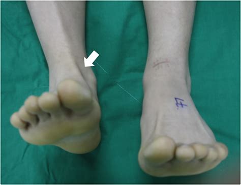 Reconstruction Of Chronic Tibialis Anterior Tendon Ruptures Using A