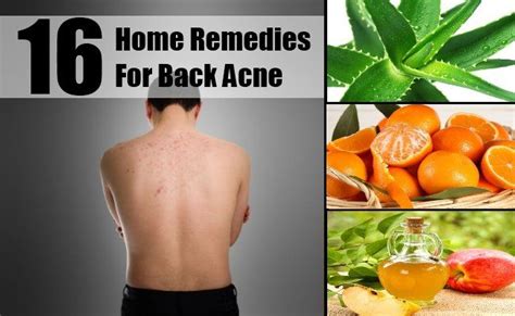 16 Home Remedies For Back Acne Natural Acne Remedies Home Remedies