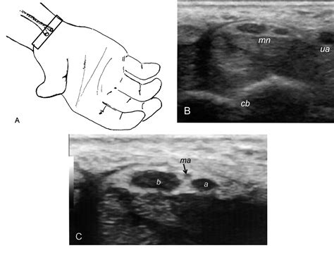 Sonographic Assessment Of A Bifid Median Nerve And Median Artery In