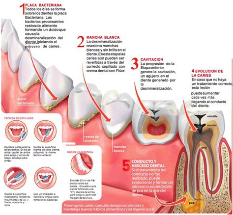 La caries dental Santa Inés Clínica Odontológica