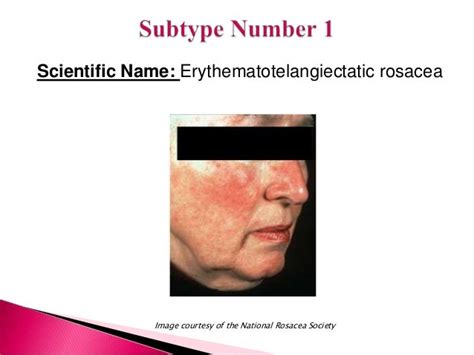 Subtypes Of Rosacea And Their Symptoms
