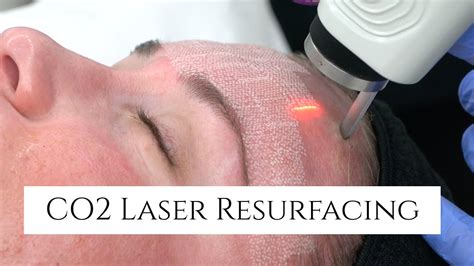 Co2 Laser Facial Rejuvenation Fix Fine Lines And Wrinkles Fix Sun