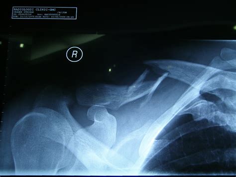 Broken Collarbone Clavicle 🩺singapore Sports And Orthopaedic Surgeon