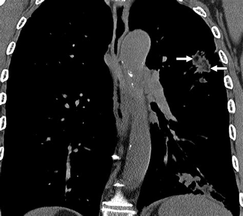 Lipoid Pneumonia Spectrum Of Clinical And Radiologic Manifestations Ajr
