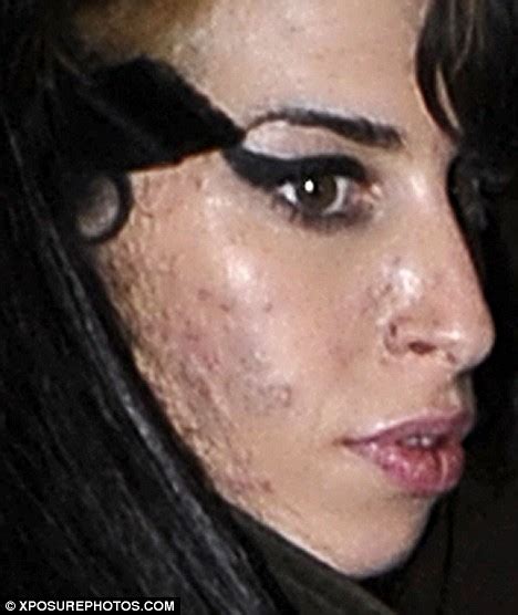 Pictured The Shocking Toll Amy Winehouses Party Lifestyle Is Having On Her Ravaged Skin