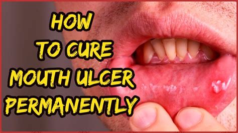 How To Cure Mouth Ulcer Faster And Reduce The Occurrence Permanently