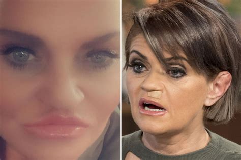 danniella westbrook reveals she s had the first of four surgeries to repair rotting face