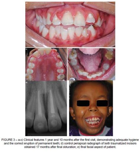 Stomatos Cri Du Chat Syndrome Conservative Dental Treatment In An 8