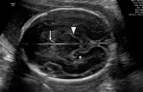 Axial View Of The Fetal Head In The Transthalamic Plane Showing The