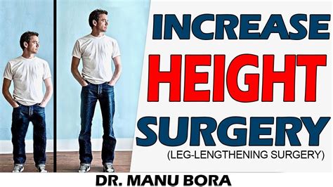 Limb Lengthening Surgery Know About Surgery To Increase Height And