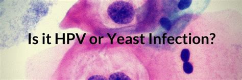 Vaginal Yeast Infection Symptoms Archives Lets Beat Yeast Infections
