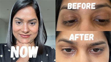 Before And After My Cholesterol Deposit Surgery Xanthelasma Removal