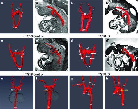 Maternal Id Causes Aortic Arch Abnormalities Comparison Of Aortic Arch
