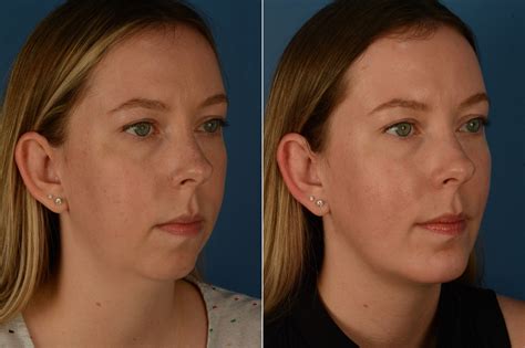 Chin Implant Neck Liposuction Photos Naples Fl Patient