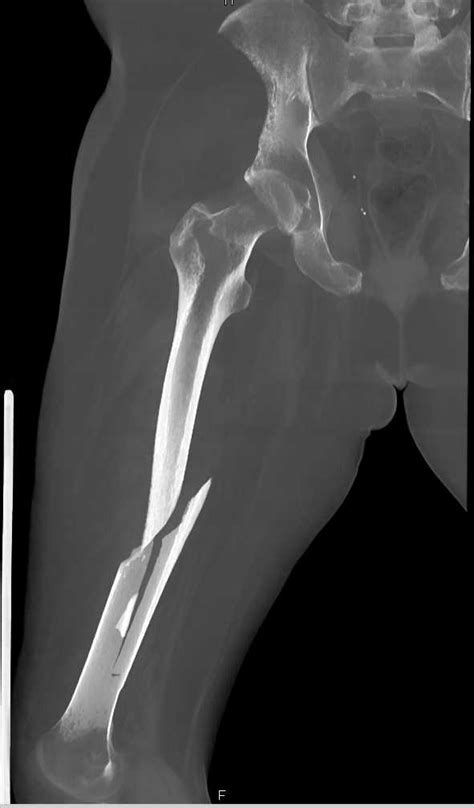 Femur Spiral Fracture X Ray Femur Fracture Images Stock Photos My Xxx