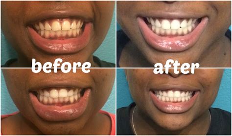 How To Use Charcoal Capsules To Whiten Teeth Teeth Poster