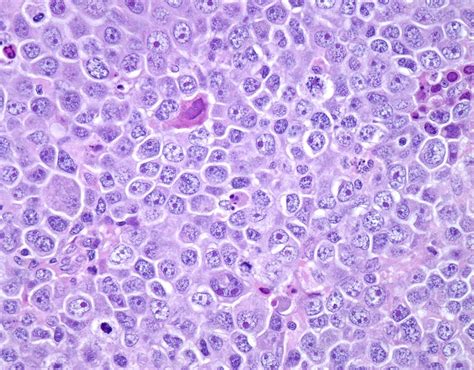 Large Diffuse B Cell Lymphoma