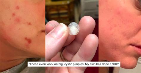 these 9 acne patches are quite possibly the most satisfying thing i ve ever seen