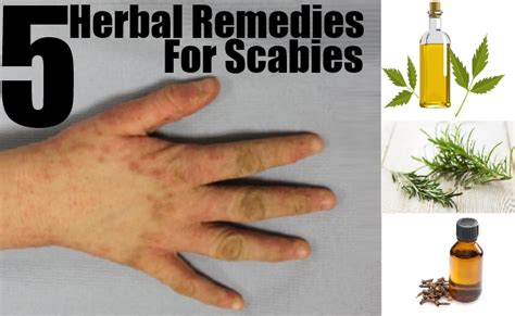 Top 5 Herbal Remedies For Scabies Treatments For Scabies Natural