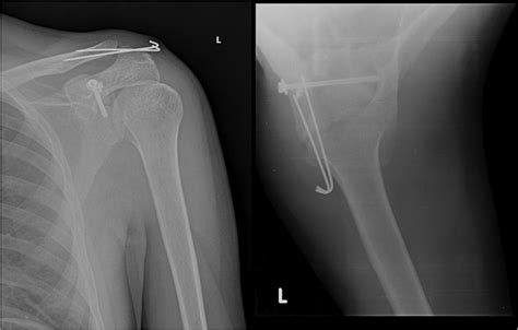 Combined Acromioclavicular Joint Dislocation And Coracoid Avulsion In