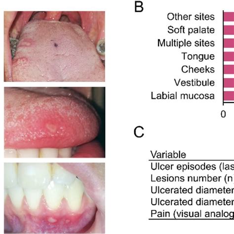 Clinical Manifestations Of Recurrent Aphthous Stomatitis A Download Scientific Diagram
