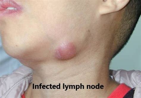 Lymph Node In Children Dr Joann Child Specialist